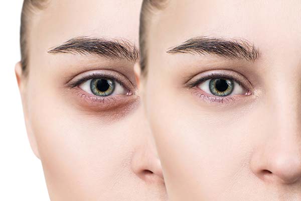 how-to-remove-dark-circles-under-the-eyes